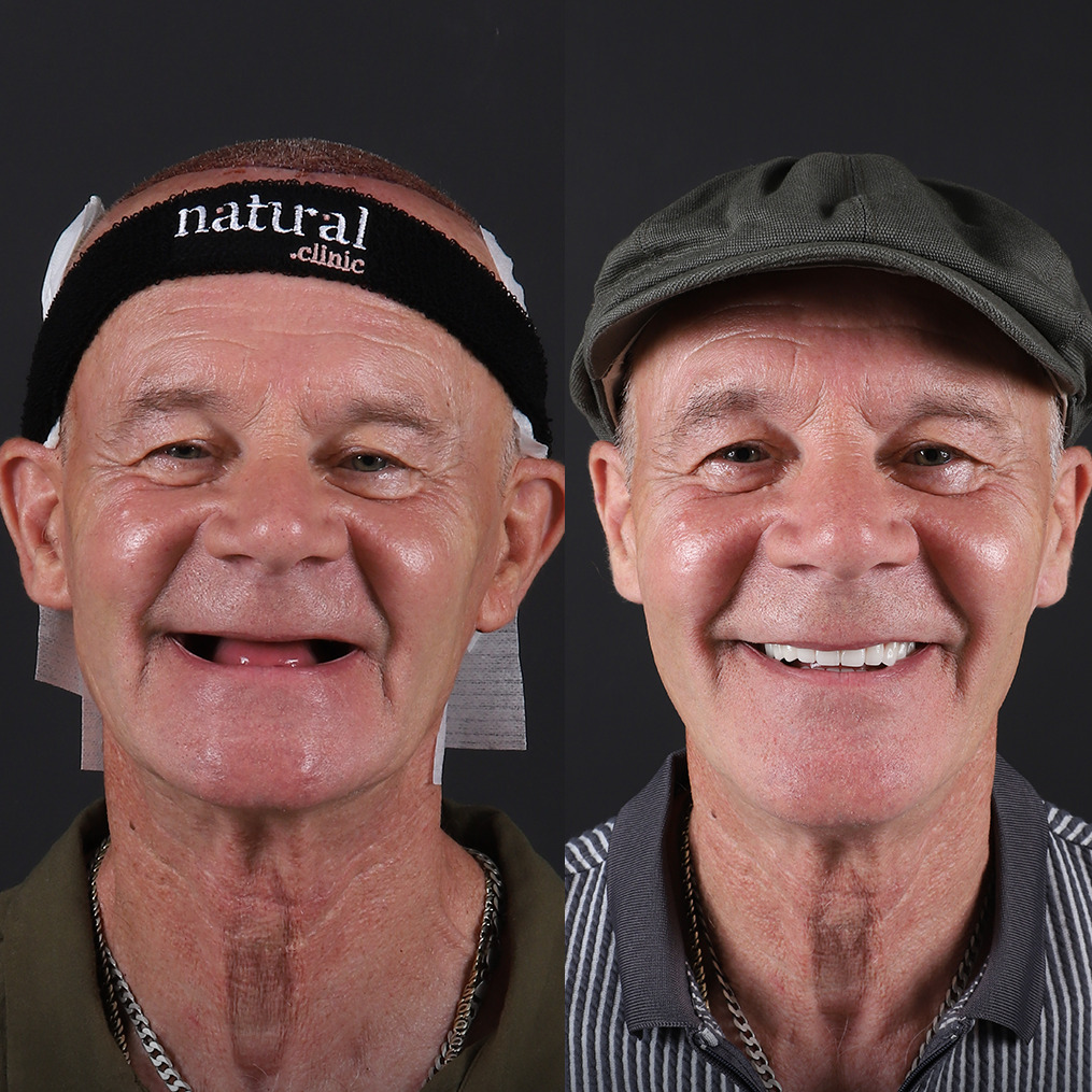 Smile Transformation