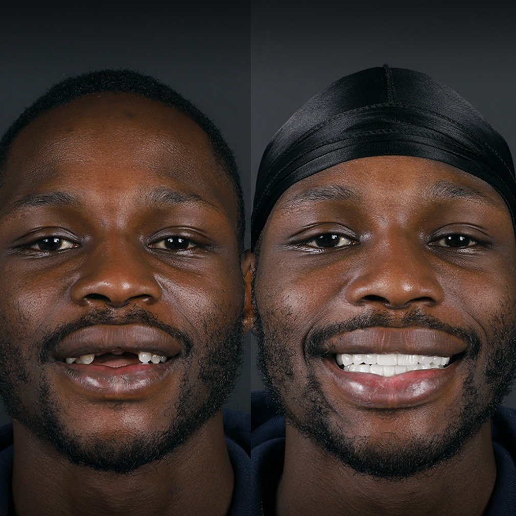 Dental Implants before and after — USA patient