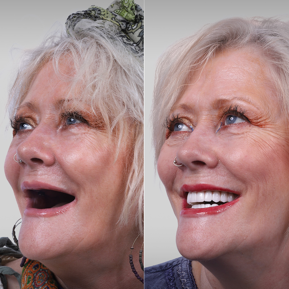 All-on-6 before and after — Germany patient