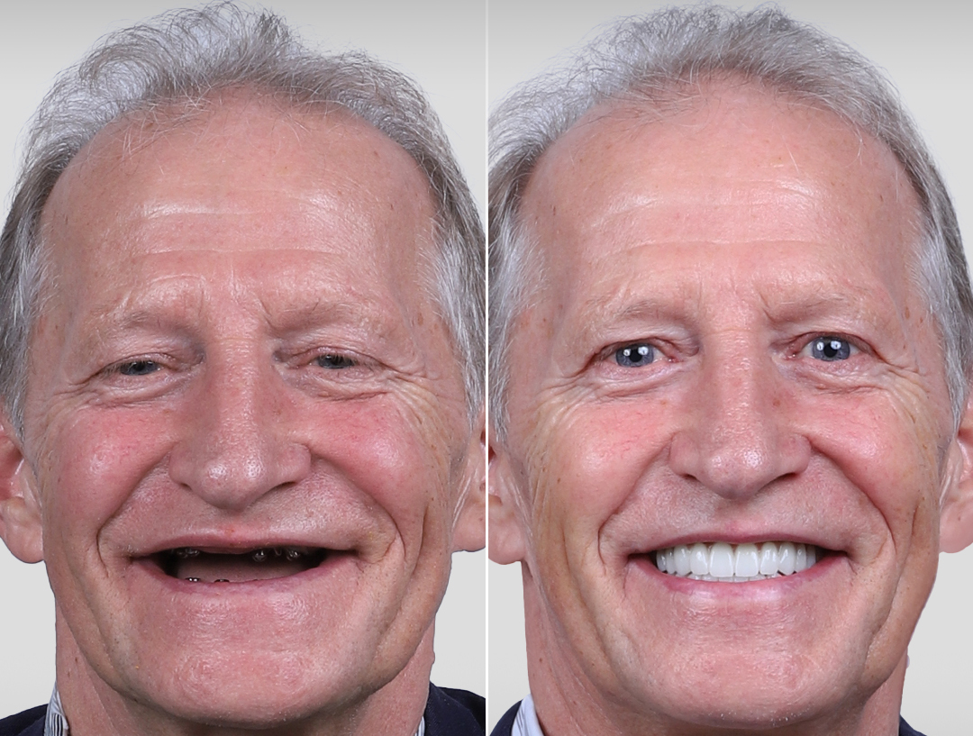 All-on-4 before and after — Netherlands patient