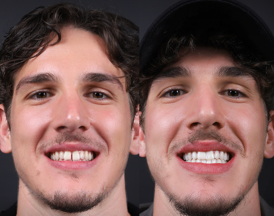 Zirconia Crowns before and after — Australia patient